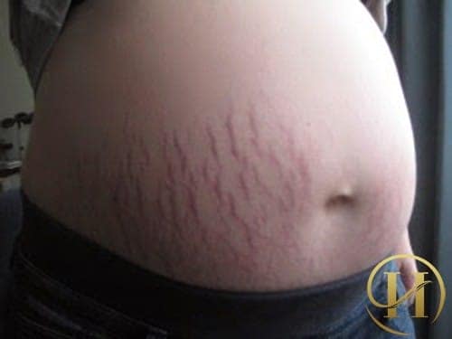 Tại sao nên trị rạn da với công nghệ Plasma C-8D