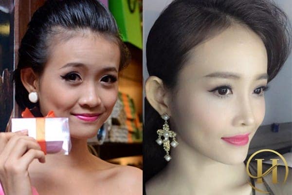 Trương Mỹ nhân đã độn trán và cấy tóc
