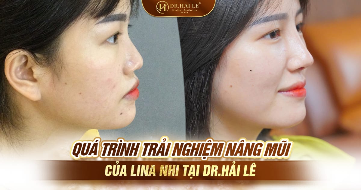 Quá trình trải nghiệm nâng mũi của Lina Nhi tại VTM Dr.Hải Lê