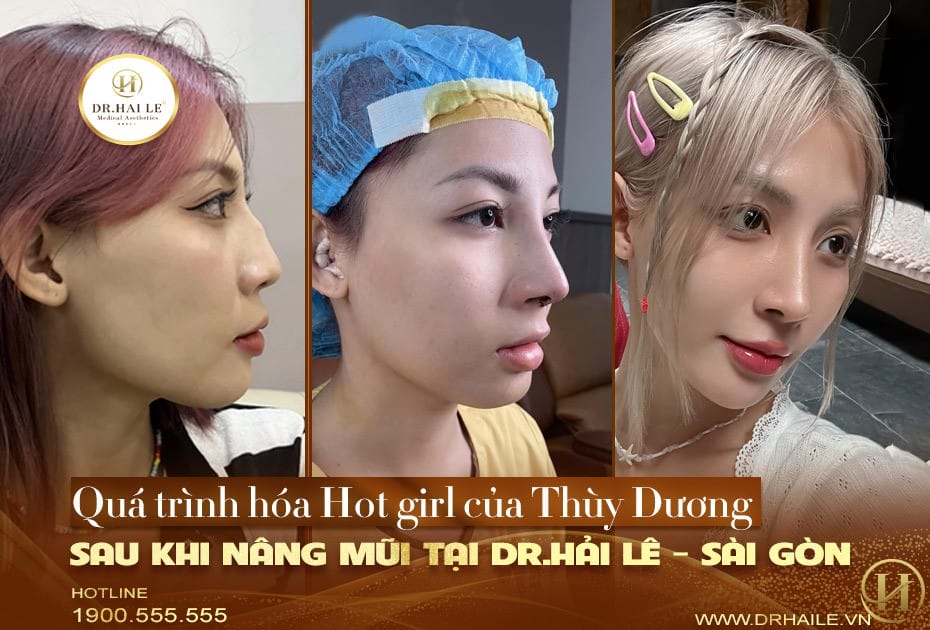 Quá trình hóa Hot girl của Thùy Dương sau khi nâng mũi tại Dr.Hải Lê Sài Gòn