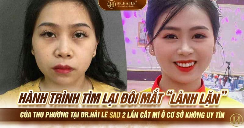 Hành trình tìm lại đôi mắt “lành lặn” của Thu Phương tại Dr.Hải Lê sau 2 lần cắt mí ở cơ sở không uy tín
