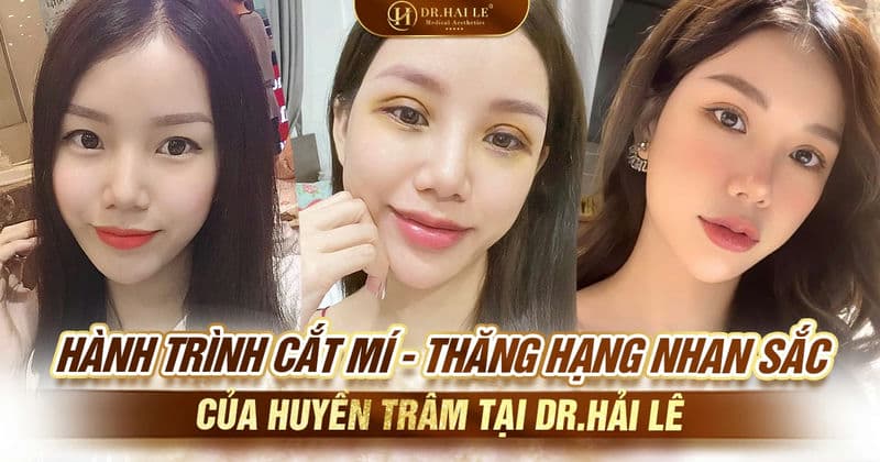 Hành trình cắt mí - thăng hạng nhan sắc của Huyền Trâm tại Dr.Hải Lê