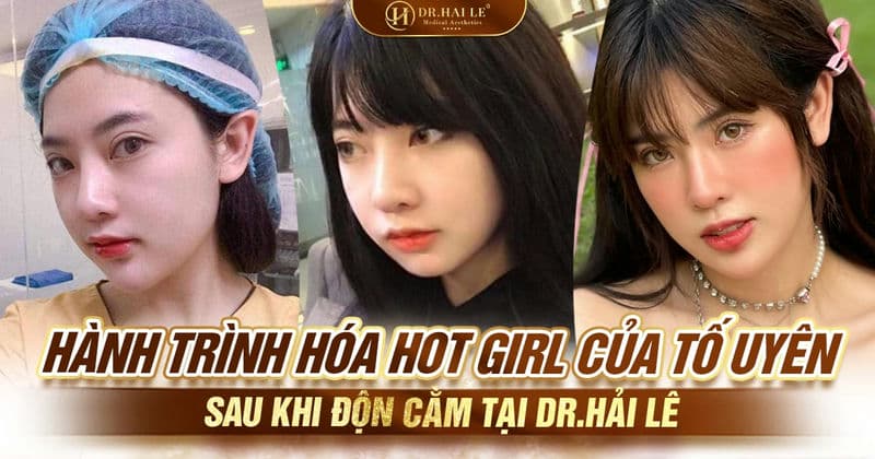 Hành trình Hóa Hot girl của Tố Uyên sau khi độn cằm tại Dr.Hải Lê