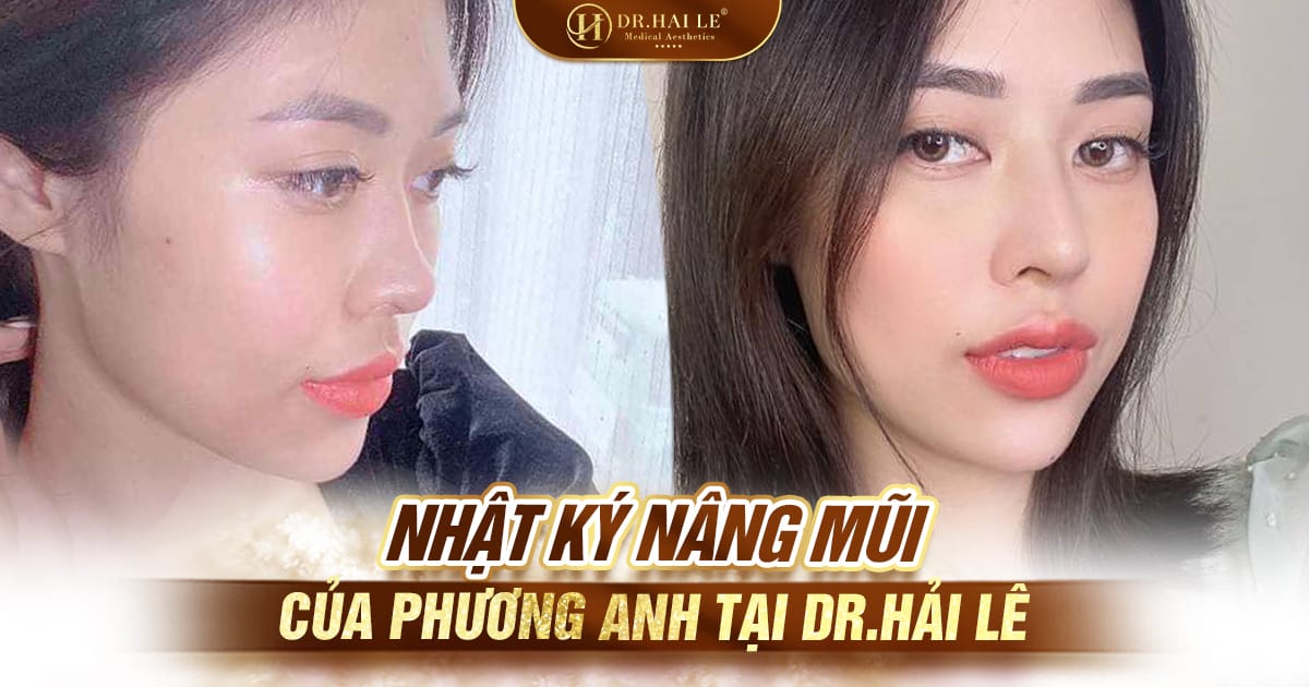 Nhật ký nâng mũi của Phương Anh tại Dr.Hải Lê