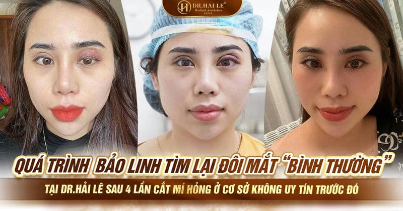 Quá trình Bảo Linh tìm lại đôi mắt "bình thường" tại Dr.Hải Lê sau 4 lần cắt mí hỏng ở cơ sở không uy tín trước đó