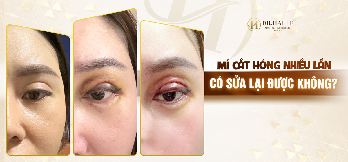 Mí lỗi hỏng nhiều lần có sửa được không? Mí lỗi hỏng nhiều lần có sửa được không?