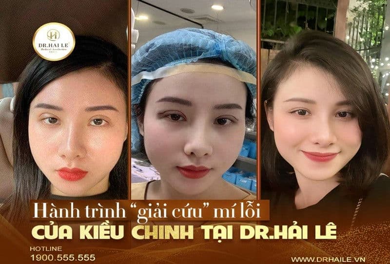 Hành trình “giải cứu” mí lỗi của Kiều Chinh tại Dr.Hải Lê