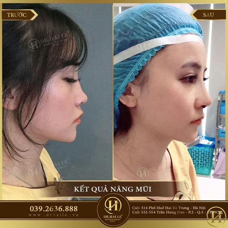Bích phương sau khi nâng mui demi tech 6D