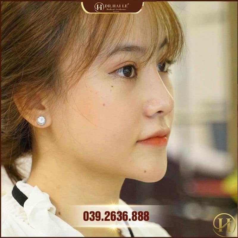 mũi Bích Phương Demi Tech 6D sau 6 tháng