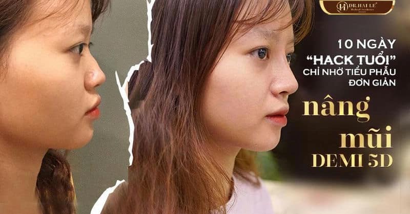 10 ngày “hack tuổi” chỉ nhờ tiểu phẫu đơn giản nhờ NÂNG MŨI DEMI 5D