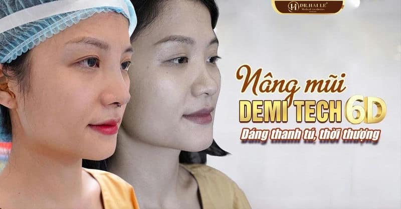 Hot girl Đặng Thanh chia sẻ bí quyết nâng mũi: Bớt to, thô, vẹo trở nên thon gọn hơn