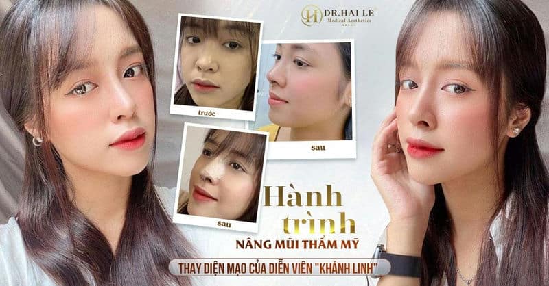 Hành trình nâng mũi - Thay diện mạo, đổi số phận của diễn viên Khánh Linh