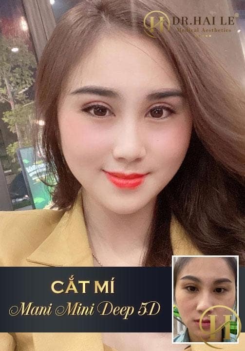 Một số lưu ý trước khi cắt mí