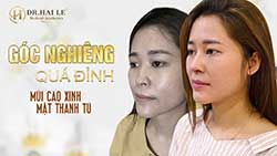 MINH CHỨNG THẨM MỸ: Cứ nâng mũi là xinh hết phần người khác rồi!