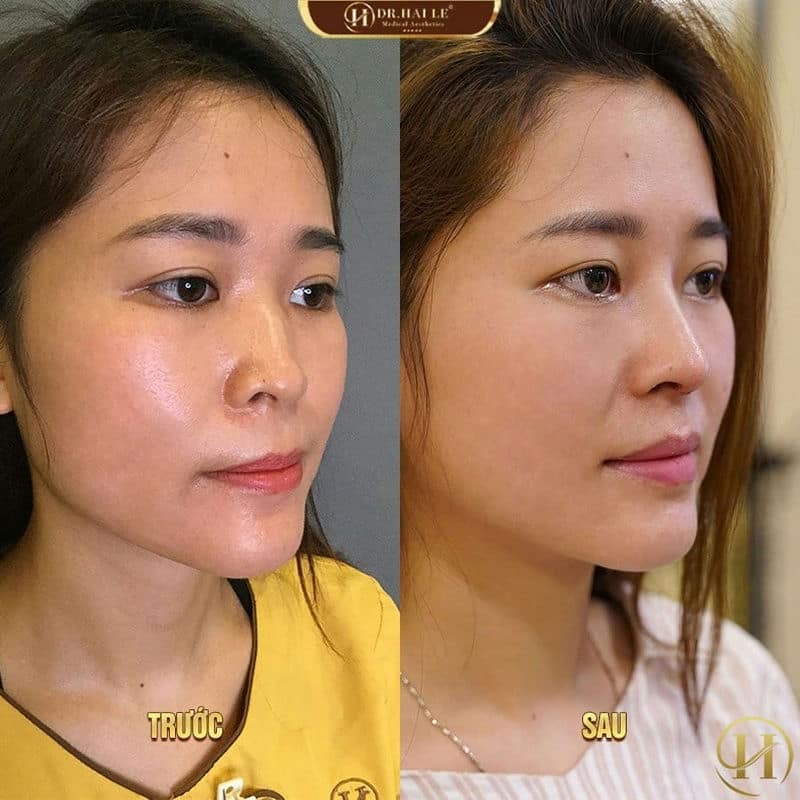 Hoài Thương 2