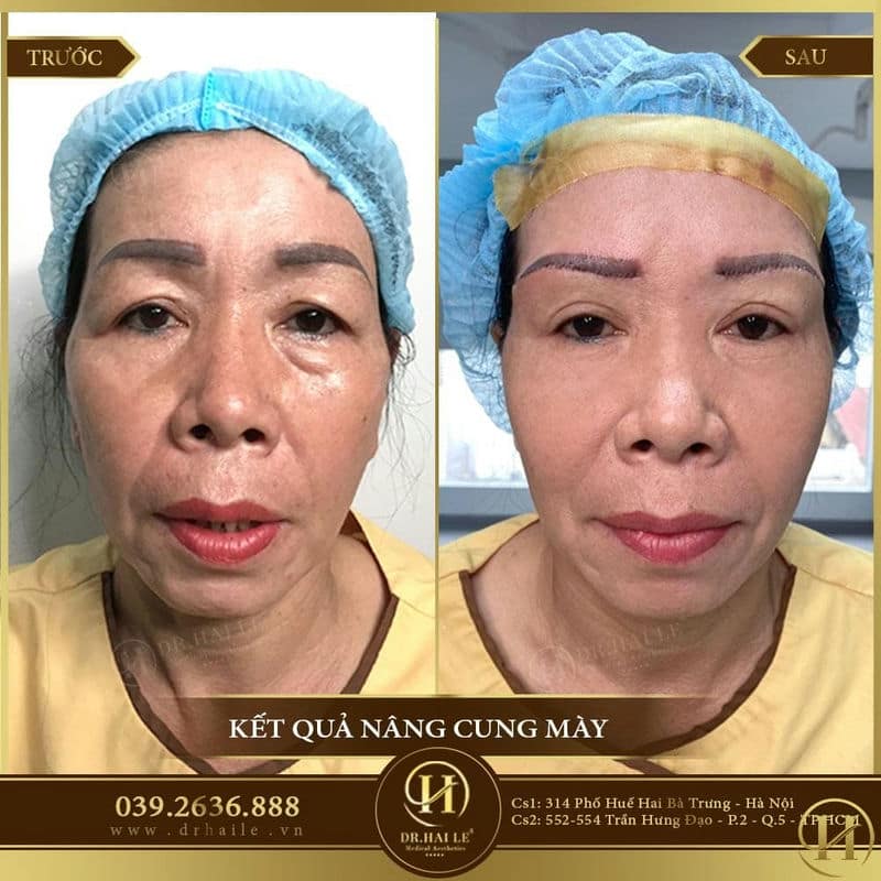 Kết quả treo cung mày Dr.Hải Lê