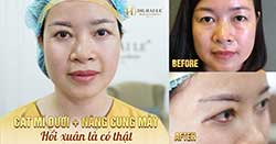 Nâng cung mày và những điều cần biết!