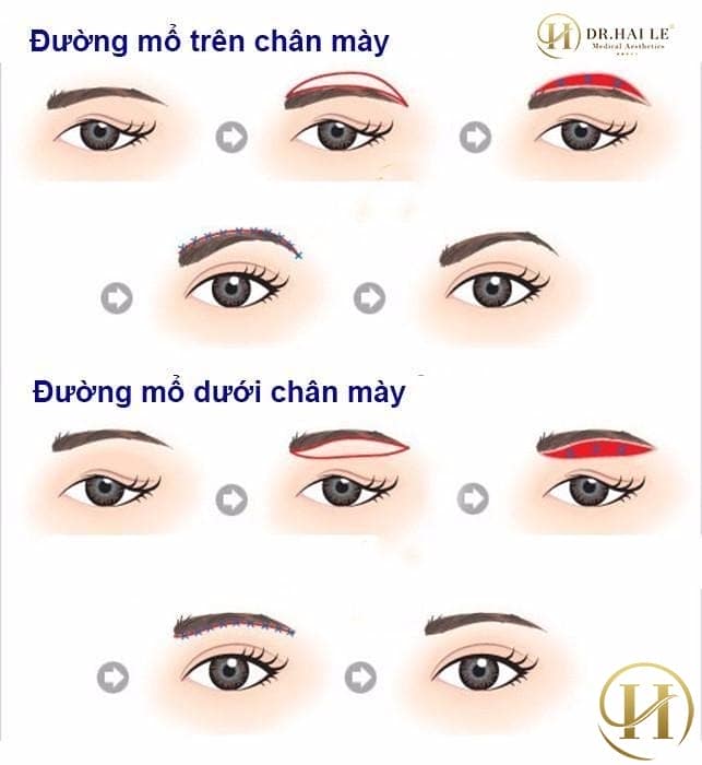 Nâng chân mày là gì?
