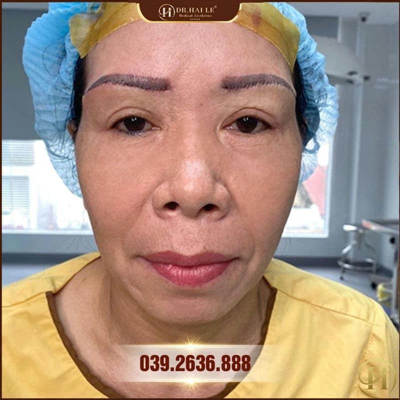 Kết quả nâng cung mày td