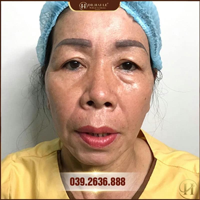 Hình ảnh trước khi nâng cung mày