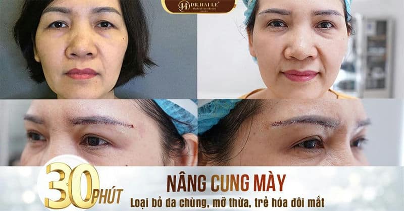 Kết quả nâng cung mày tại Dr.hải lê - Một tiểu phẫu nhỏ - Một hạnh phúc to