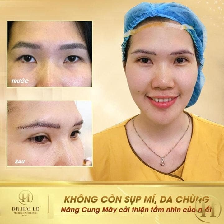 nâng cung mày loại bỏ da chùng