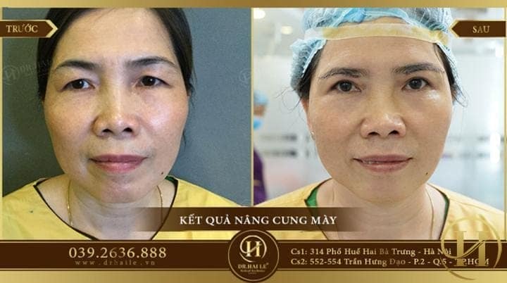 kq nâng cung mày