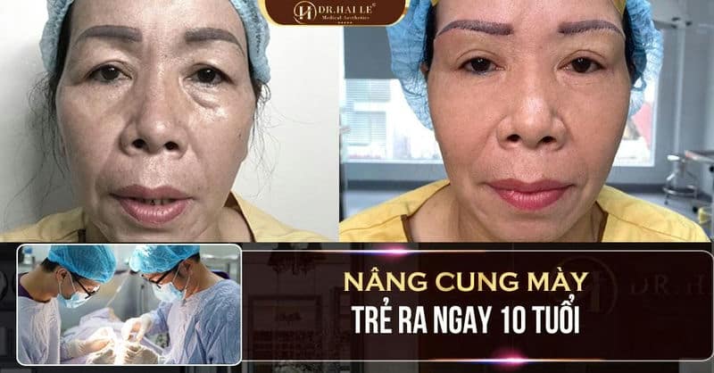 Nâng cung mày - Giải pháp cho gương mặt trẻ trung hơn, tại sao không?