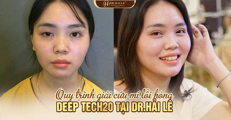 Quy trình giải cứu mí lỗi hỏng DEEP TECH20 tại Dr.Hải Lê