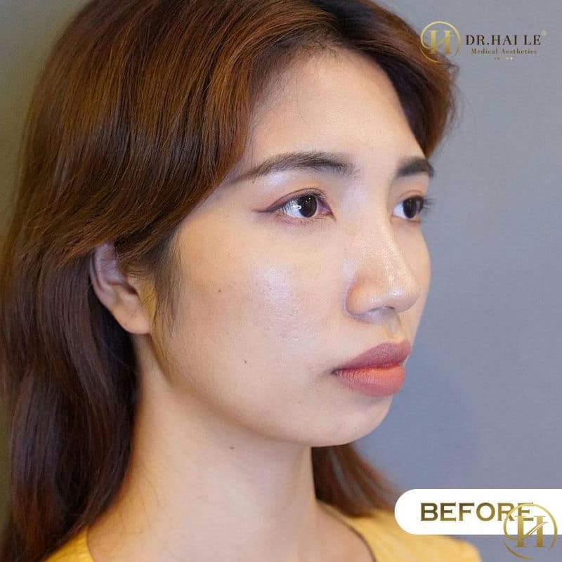 Thu Quỳnh trước khi độn cằm