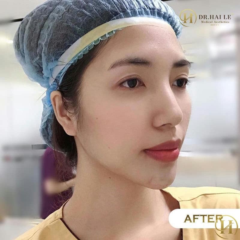 Thu Quỳnh sau khi độn cằm