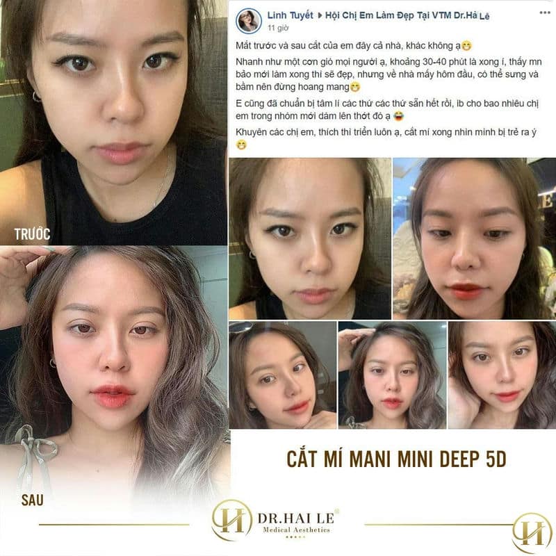 Tuyết Linh cảm nhận sau khi cắt mí