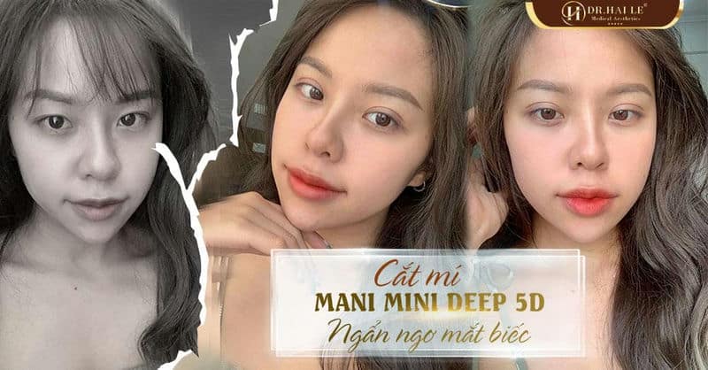 Cắt mí Mani Mini Deep 5D - Ngẩn ngơ măt biếc!
