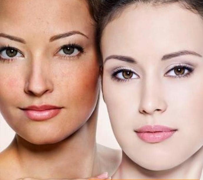 Công nghệ trị nám Laser Diamond Square