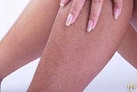 Làm cách nào để triệt lông toàn thân