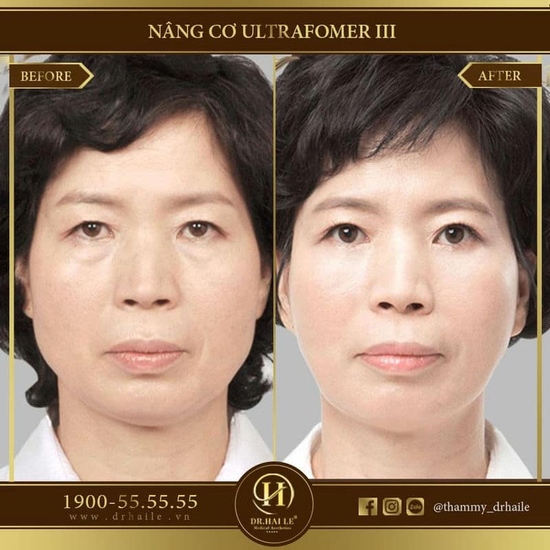 Ảnh trước sau