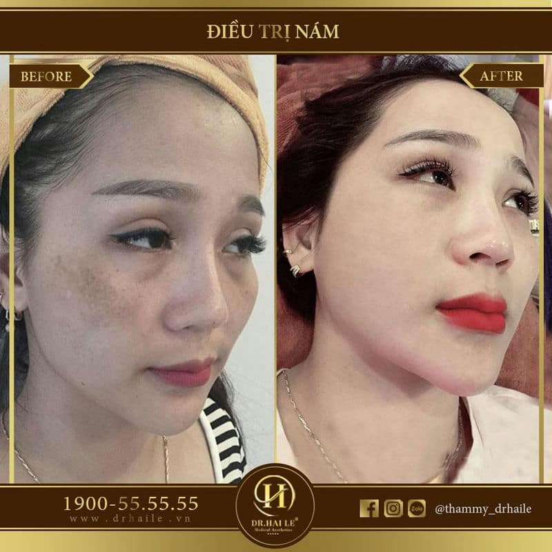 Trị tàn nhang bằng Laser Spectra Elos