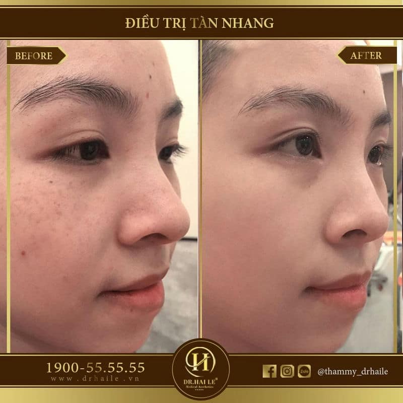 Trị tàn nhang bằng Laser Spectra Elos