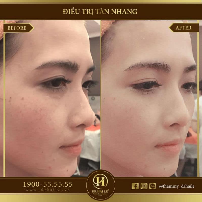 Trị tàn nhang bằng Laser Spectra Elos