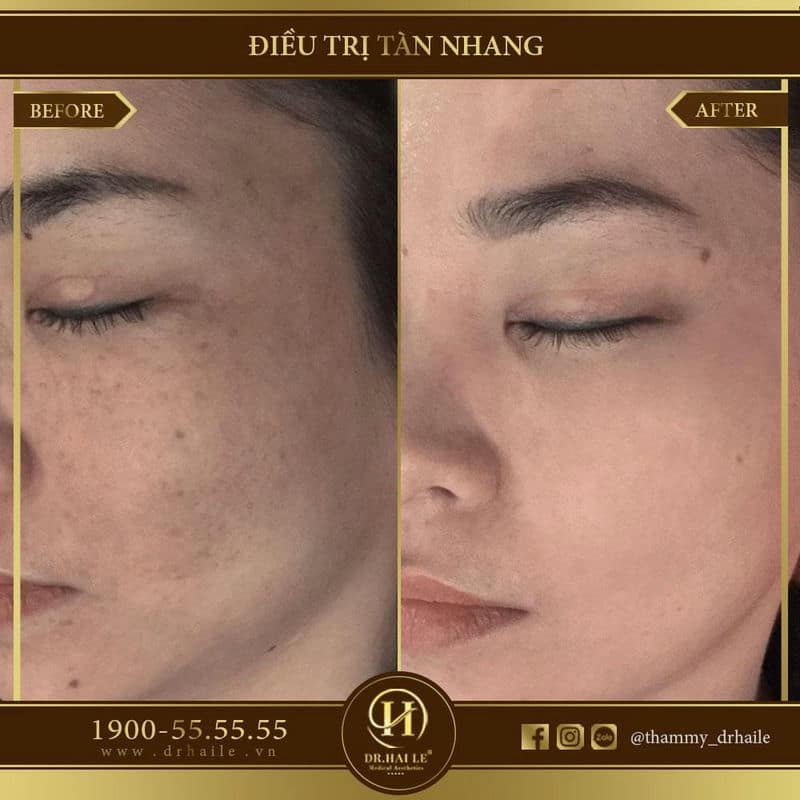 Trị tàn nhang bằng Laser Spectra Elos