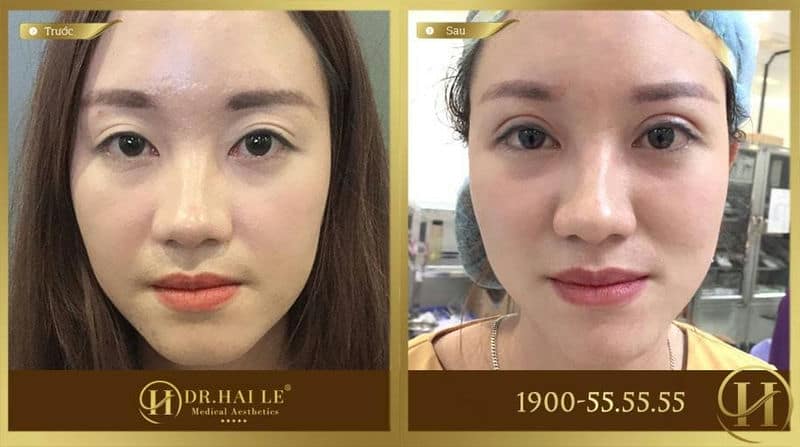 Hình ảnh khách hàng trước và sau cắt mí tại Dr. Hải Lê