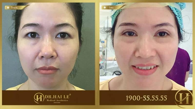 Khách hàng trước và sau khi cắt mí tại Dr. Hải Lê
