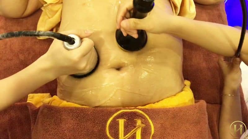 Công nghệ giảm mỡ bụng Lipo 5s không phẫu thuật