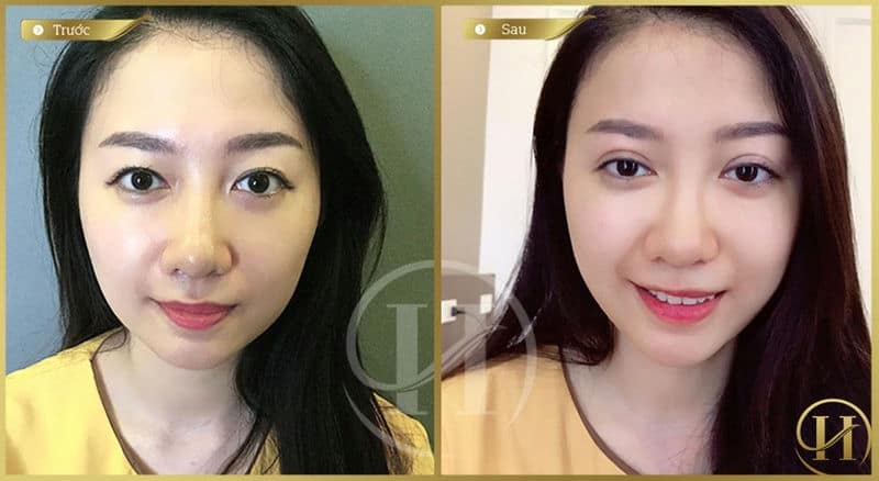 Thay thế nếp mí mờ nhạt bằng đường mí sâu, rõ nét
