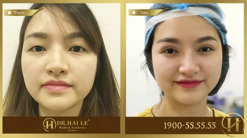 Cắt mí 5D cho đôi mắt đẹp vượt thời gian