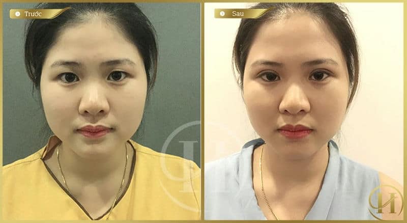 Sớm nói lời tạm biệt sụp mí nhờ cắt mí 5D