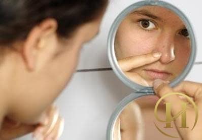 Tuyệt đối không được nặn mụn ở phần chóp mũi