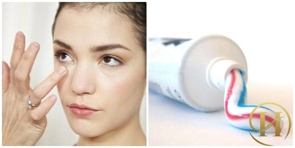 Cách xóa bỏ mụn thịt bằng kem đánh răng