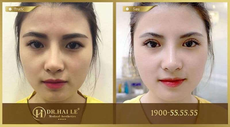 Cắt mí Mini Deep 5D cho đôi mắt đẹp với hàng mi cong tự nhiên