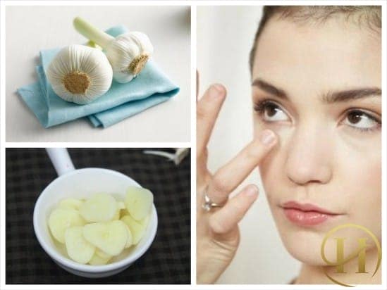 Ngạc nhiên với công thức trị mụn thịt trên mặt bằng tỏi